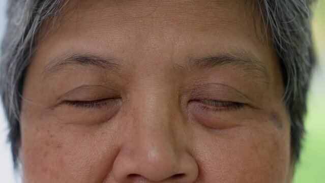Close up of the senile cataract during eye examination. A white cloudy disc is seen in black eye circle, mature cataract, nuclear sclerosis cataract. Close up half face view