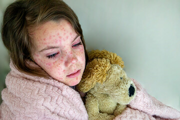 Natural vaccination. Contagious disease. Sick child with chickenpox.