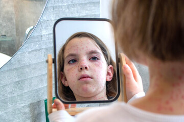 Natural vaccination. Contagious disease. Sick child with chickenpox.