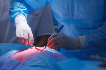 Surgery doctor sews up punctures in abdominal cavity with thread after using laparoscopic...