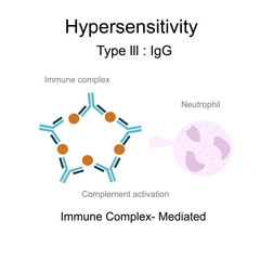 The diagram of Hypersensitivity type lll : Immune complex -Mediated that shows the Immune complex of Antigens and Antibodies indued complement activation , neutrophil and Inflammation Process. - obrazy, fototapety, plakaty