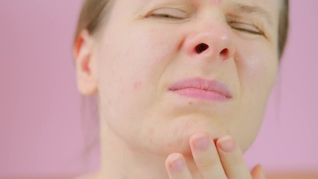 Close up skin with acne, peeling and enlarged pores. Dry skin with inflammation. Woman touching acne on her face. Skin problems, allergic, redness. Healing pimples. Pimple squeezing. 4K Video