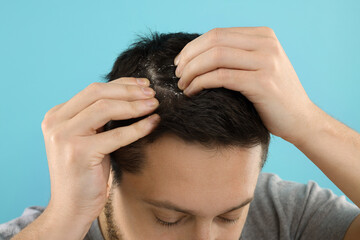 Fototapeta premium Man with dandruff in his dark hair on light blue background, closeup
