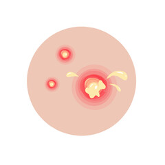 Fototapeta premium Type of acne infographic 