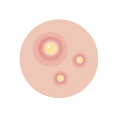 Type of acne infographic 