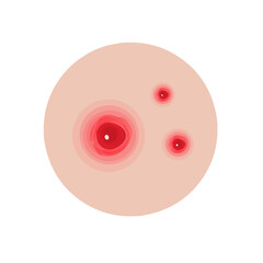 Type of acne infographic 