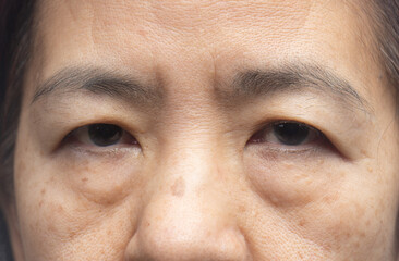 Senior asian woman worry about eye bags and dark spot. - obrazy, fototapety, plakaty