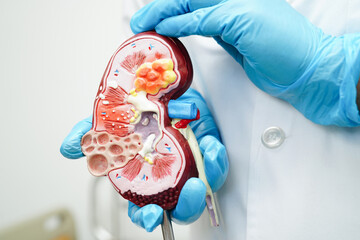 Chronic kidney disease, doctor with model for treatment urinary system, urology, Estimated...