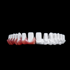 Fototapeta na wymiar zircon bridge on 8 dental implants
