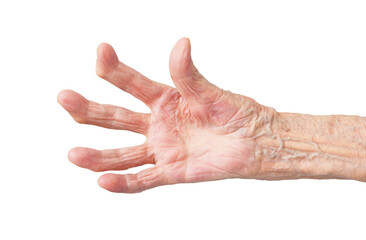 Rheumatoid polyarthritis of the hand of a 95 year old woman isolated on a white background.