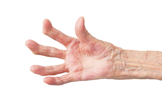 Rheumatoid polyarthritis of the hand of a 95 year old woman isolated on a white background.