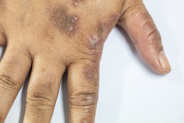 Atopic dermatitis (AD), also known as atopic eczema, is a type of inflammation of the skin...