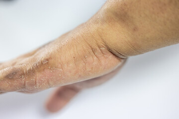 Fototapeta premium Atopic dermatitis (AD), also known as atopic eczema, is a type of inflammation of the skin (dermatitis).