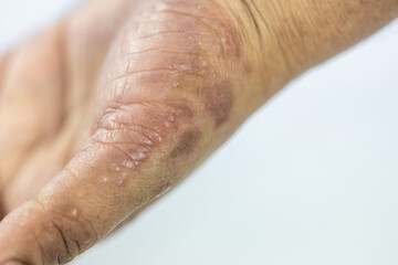 Atopic dermatitis (AD), also known as atopic eczema, is a type of inflammation of the skin (dermatitis).