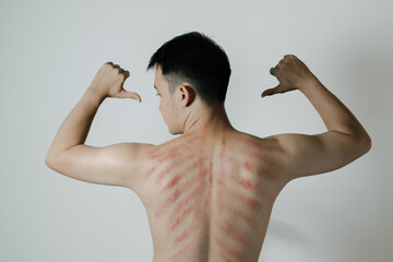 Red marks from scraped coin on a man's back. Javanese traditional alternative non-medical treatment...