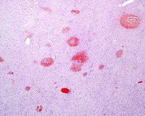 Cerebral microhemorrhages