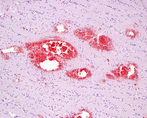Cerebral microhemorrhages