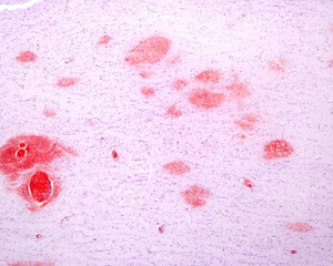 Cerebral microhemorrhages