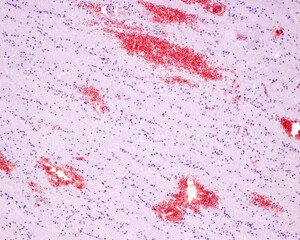 Cerebral microhemorrhages