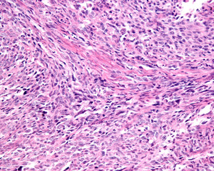 Human uterus. Sarcoma