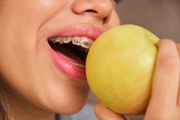 Close up of female teenager mouth with braces eating an apple.