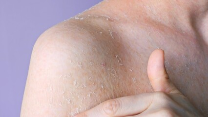 Fototapeta premium Problematic dry skin on shoulder close-up front view flaking as consequence of dry skin dehydration and dermatitis, concept of health problem dry skin and personal hygiene self care