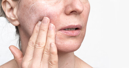 A woman with enlarged pores uses cosmetic face cream. Dermatological preparation for facial skin.
