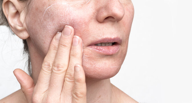 Enlarged Pores" Images – Browse 398 Stock Photos, Vectors, and Video |  Adobe Stock
