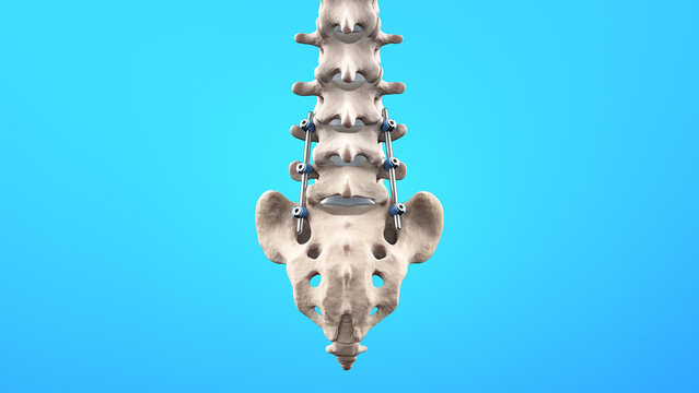 Posterior Lumbar Fusion with Pedicle Screws and Rods