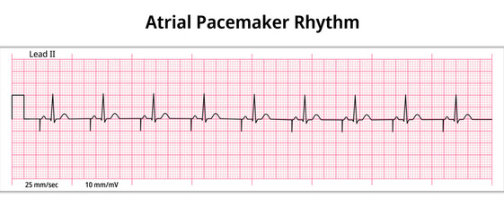 ECG Atrial Pacemaker Rhythm - Single Chamber - 8 Second ECG Paper - Electrocardiogram Vector Medical Illustration