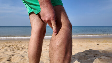 Person on a sandy beach pointing to a leg muscle with beach fly bites, beach flea bites against a backdrop of calm sea, possibly indicating leg pain or muscle injury