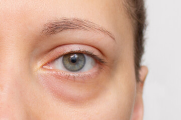 The face of a young woman with a bag under her eye close-up. Swelling of the lower eyelid. Bruises...