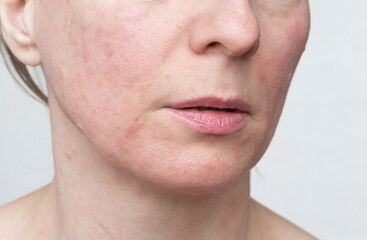 Close-up portrait of a woman with inflamed skin on her face. Cosmetics for clean and natural skin for middle-aged women.