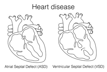 Heart. Atrial Septal Defect. Ventricular Septal Defect