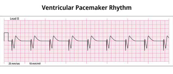 ECG Ventricular Pacemaker Rhythm - Single Chamber - 8 Second ECG Paper - Electrocardiography Vector Medical Illustration