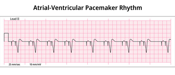 ECG Atrial Ventricular Pacemaker Rhythm - Dual Chamber - 8 Second ECG Paper - Electrocardiography Vector Medical Illustration