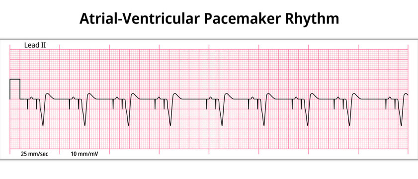 ECG Atrial Ventricular Pacemaker Rhythm - Dual Chamber - 8 Second ECG Paper - Electrocardiography Vector Medical Illustration