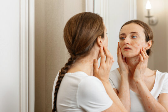 The girl looks at her problem skin in the mirror. The phase of exacerbation of psoriasis and its manifestations.