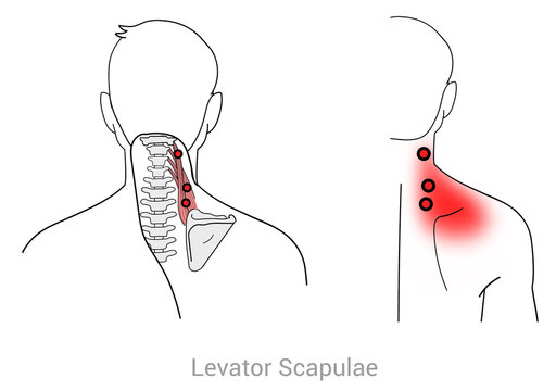 Levator Scapulae: Myofascial trigger points and associated pain locations