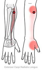 Extensor Carpi Radialis Longus: Myofascial trigger points and pain locations