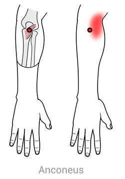 Anconeus: Myofascial trigger points and associated pain locations