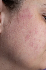 Red rash eczema on a woman face due to live disease , close up texture - obrazy, fototapety, plakaty
