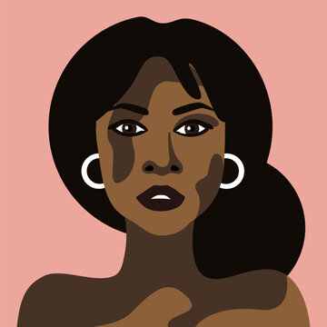 Young beautiful mulatto woman with vitiligo skin disease vector