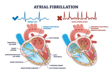 Atrial fibrillation as abnormal heart beat frequency disease outline diagram. Labeled educational scheme with cardiovascular condition and heart structure vector illustration. Anatomical explanation. - obrazy, fototapety, plakaty