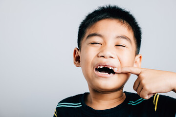 Asian boy with missing front tooth symbolizes dental health care while pointing. White background concept of dental growth care and oral hygiene. Children show teeth new gap, dentist problems