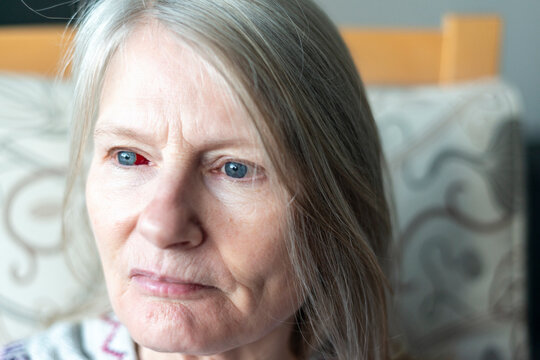 Subconjunctival Hemorrhage in the right eye of a middle aged woman, at her home,Worcestershire,England,UK.