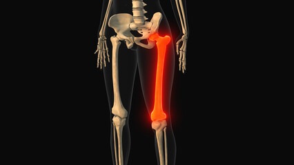 Medical animation of the femur bone pain