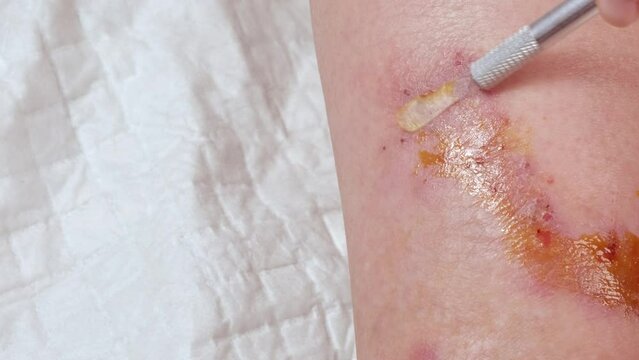 doctor, nurse heals wound on female leg with medicine, medical concept, venous ulcers, diabetes mellitus, healing ulcers, eliminating inflammatory process, sanitation pathogenic microflora