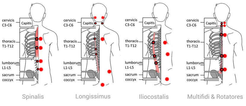 Iliocostalis, Longissimus  Spinalis, Multifidi & Rotatores: Myofascial trigger points and associated pain locations