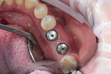 Concept of modern procedure in dentistry, multi unit abutment, real human mouth, upper row. Dental...